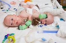 conjoined twins separated successfully frati operatie separation carter conner reusita separare jacksonville fla undergo