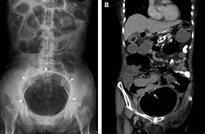 bladder scan abdominal distended abdomen urinary pelvic bmj emj