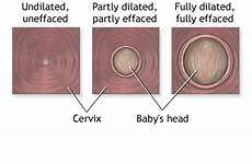 birth cervix dilation vaginal baby part cervical labor procedure when delivery canal finger open medlineplus looking head fully dilate series