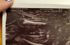weeks twins pregnant ultrasound twiniversity week twin