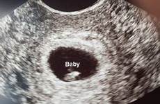 ultrasound pregnancy cramping spotting developing