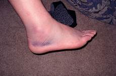 swollen ankles causes pregnancy symptoms ankle treatment swelling foot feet healthool