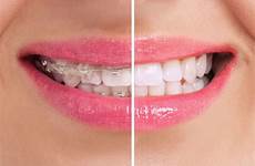 braces orthodontics price dental range