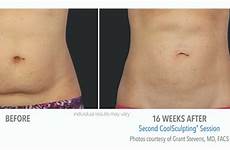 coolsculpting before after fat abdomen laser patient real reduction