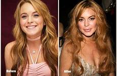 surgery plastic before after lindsay lohan celebrity worst gone wrong disasters celebrities bad hollywood top nose surgeries fails job women
