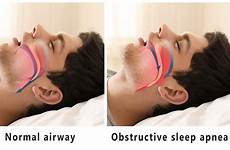 apnea sleep treatment snoring