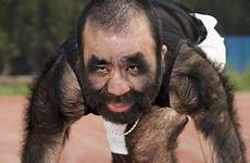 peloso adam hairiest maymun lobo komik yu zhenhuan resim estetik creeis peor viralands brandon hipertricosis depila depilazione maschile syndrome strano