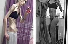 after before anorexia body sufferer former shocking check these updates latest die many