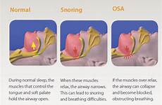 snoring apnoea obstructive osa apnea snore disease pressure blood severe throat