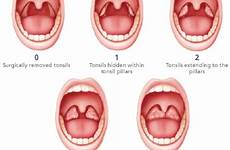pediatric apnea obstructive tonsils osa uvula airway ent