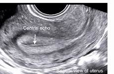 uterus ultrasound sagittal transvaginal endometrium