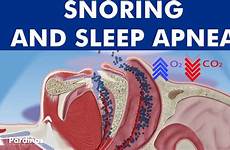 apnea snoring