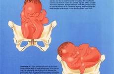 transverse baby lie position fetal head smyrna
