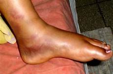ankle salter harris fracture foot swollen swelling type ecchymosis feet ankles causes ii cases physeal review
