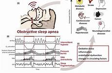 sleep apnea osa obstructive mechanisms pathophysiological