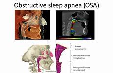 sleep obstructive apnea osa airway obstruction relationship dentofacial structures