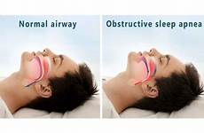 apnea obstructive explained