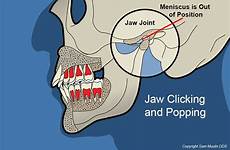 jaw tmj clicking popping grinding cause