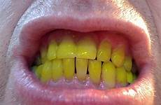 teeth yellow publicdomainpictures dents jaunes stock