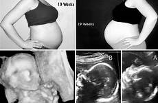 belly pregnant singleton pregnancy twings