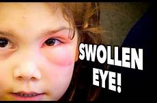 eye swollen cellulitis periorbital