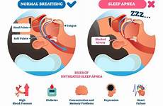 apnea symptoms obstructive osa breathing asleep dental