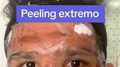 #peeling con #fenol #dermatologia #cicatriz #cara | Dr.Movimiento