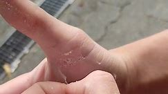 skin peeling at its finest😍 #satisfyingvideo #fyp #peelingskin #peeling #satisfying #asmrvideo #fy