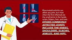 Rheumatoid Arthritis (RA): Symptoms, Causes and Treatment | Merck Manual Consumer Version
