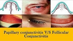 CONJUNCTIVITIS | papillae v/s follicles and membranes
