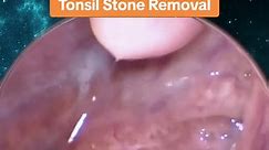 Tonsil stone removal by Doctor John. Only performed by a specialist #tonsilstonesremoval #tonsilstones #tonsils
