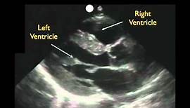 Cardiac Ultrasound - Parasternal Long Axis - Part 1 - Sonosite, Inc.