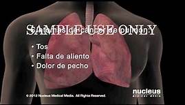 Síntomas del cáncer de pulmón