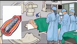 Koronarangiographie und Einsetzen eines Stent in die Herzkranzarterien