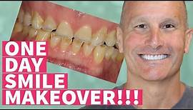 New Teeth in One Day Smile Makeover with Dental Veneers and Crowns