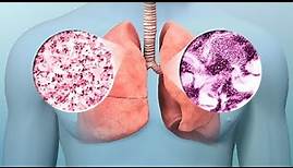 Comprender el cáncer de pulmón