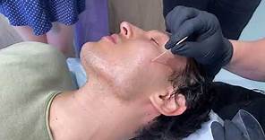 HOW TO GET RID OF ICE-PICK ACNE SCARS | TCA Cross to Face for Deep Acne Craters | Dr. Jason Emer