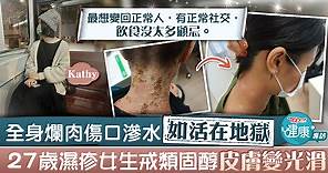 【對抗濕疹】全身爛肉傷口滲水如活在地獄　27歲濕疹女生戒類固醇皮膚變光滑 - 香港經濟日報 - TOPick - 健康 - 醫生診症室