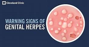5 Warning Signs of Genital Herpes