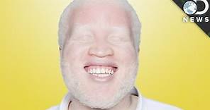 Why Are Some People Albino?