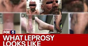 What is leprosy and why is it on the rise again? | FOX 5 News