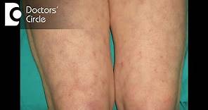 Purple lace type of discoloration on lower extremities signify Livedo Reticularis - Dr. Nischal K