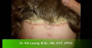 Dr Kin Leung Naturopathic Case Review Patient with Psoriasis Vulgaris plaque silver scales on scalp