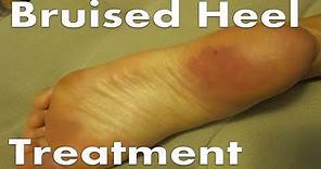 Bruised Heel Pain Treatment [BEST Home Remedies 2020!]