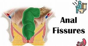 Anal Fissures - Causes, Risk Factors, Pathophysiology, Signs & Symptoms, Diagnosis, & Treatment