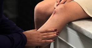 Cuidado Adecuado para Heridas: Cómo minimizar una Cicatriz