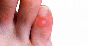 How to Prevent & Treat Foot Blisters | Foot Care