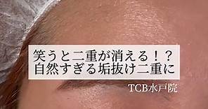 #二重整形 #水戸市 #TCB #東京中央美容外科 #二重埋没