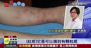 腿上紅疹誤認皮膚病中年男胰臟癌末期