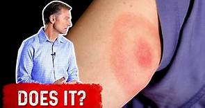 Does the Bullseye Rash Mean Lyme Disease?